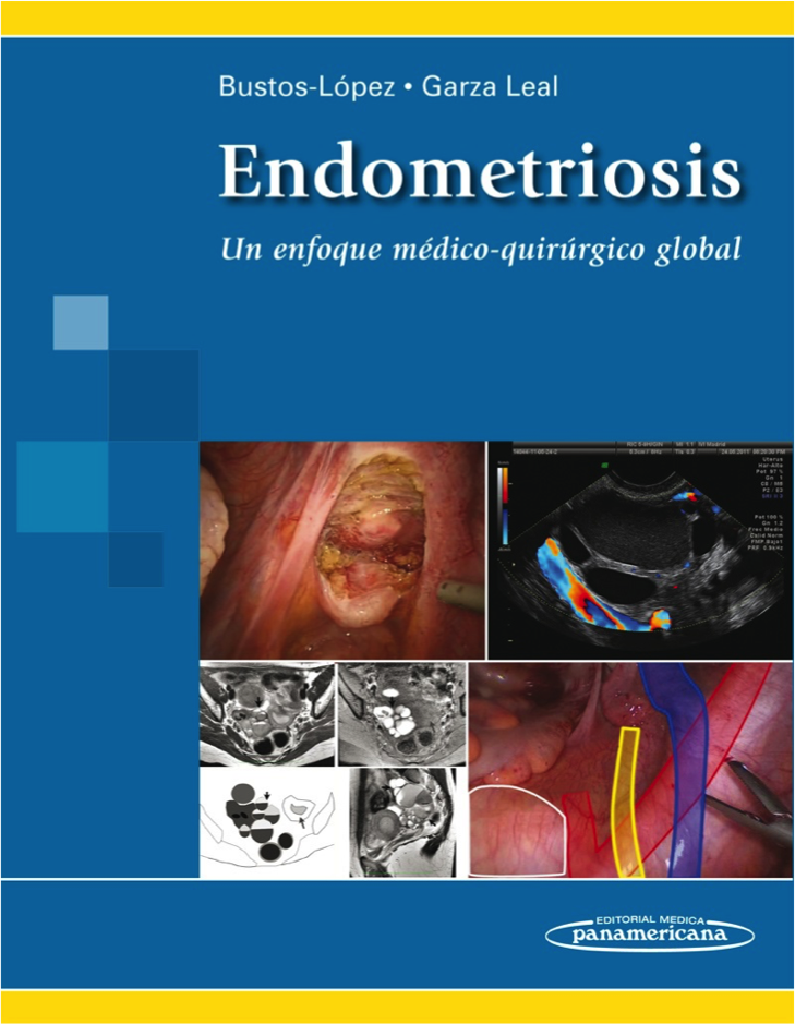 1478822109Endometriosis