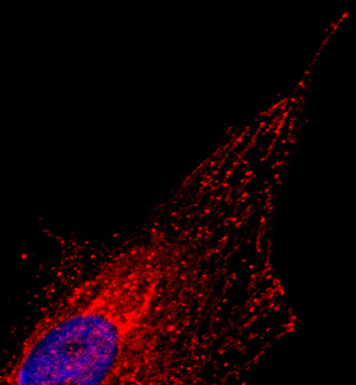 Celula cancerosa marcada con anti TWIK1